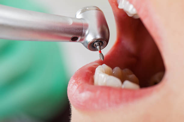 Best Chipped Tooth Repair Near Me  in Fairview Heights, IL